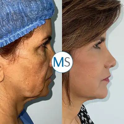 Img-Dr_Mauricio_Serrano-CirugiaIndividual-Antes_Despues-2025-estiramiento-facial-bogota-LCP