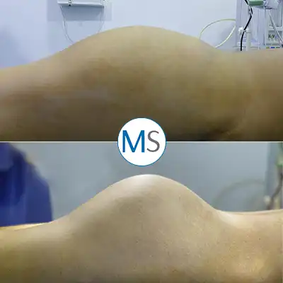 Img-Dr_Mauricio_Serrano-CirugiaIndividual-Antes_Despues-2025-gluteoplastia-bogota-LCP