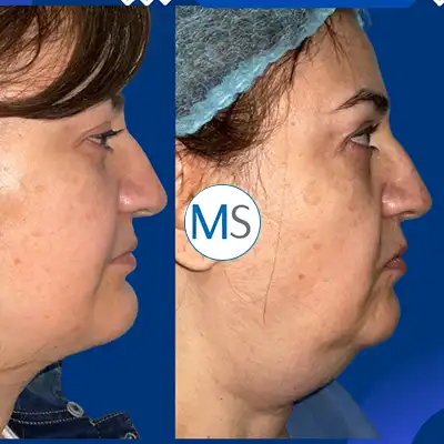 Img-Dr_Mauricio_Serrano-CirugiaIndividual-Antes_Despues-2025-lipopapada-bogota-LCP
