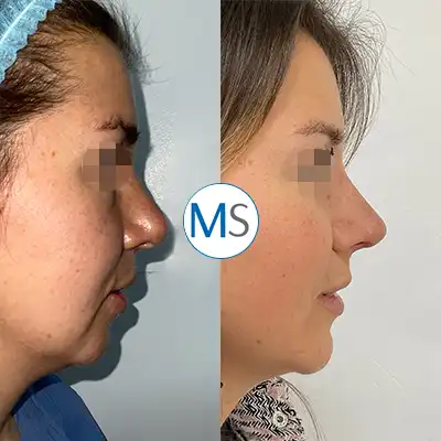 Img-Dr_Mauricio_Serrano-CirugiaIndividual-Antes_Despues-2025-mentoplastia-bogota-LCP