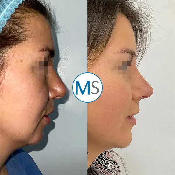 Img-Dr_Mauricio_Serrano-CirugiaIndividual-Antes_Despues-2025-mentoplastia-bogota