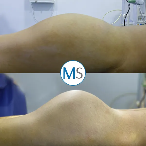 Img-bbl-surgery-in-bogota-colombia-1