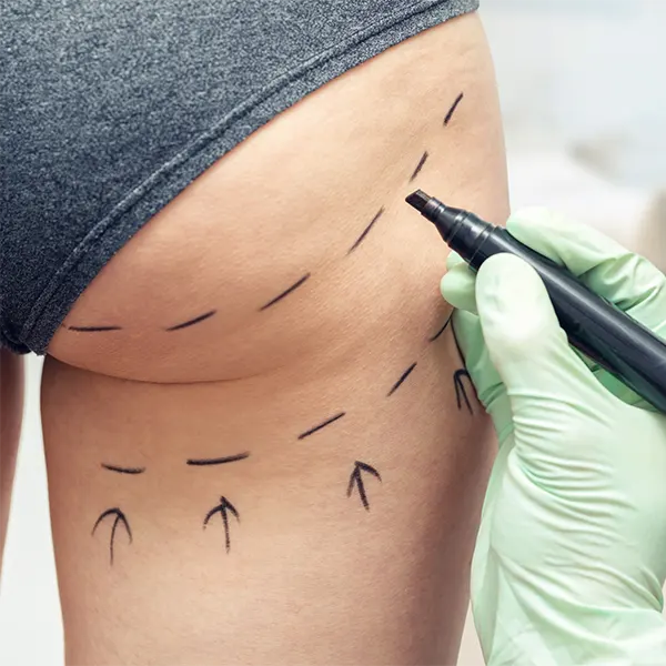 Img-bbl-surgery-in-bogota-colombia-2