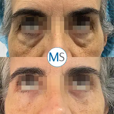 Img-blefaroplastia-bogota-1-LCP