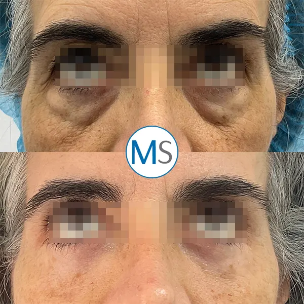 Img-blefaroplastia-bogota-1