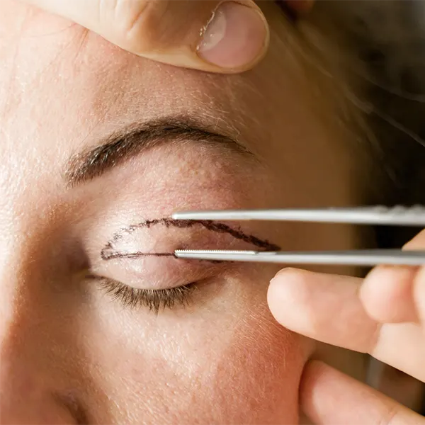 Img-blepharoplasty-in-bogota-colombia-2