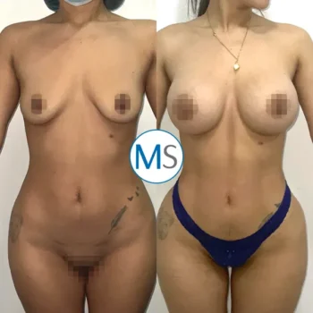 Img-breast-augmentation-bogota-colombia-1