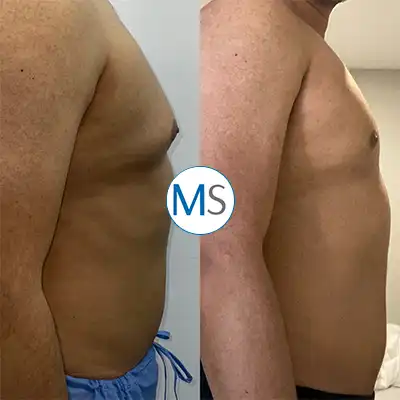 Img-gynecomastia-surgery-in-bogota-colombia-1-LCP