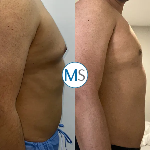 Img-gynecomastia-surgery-in-bogota-colombia-1