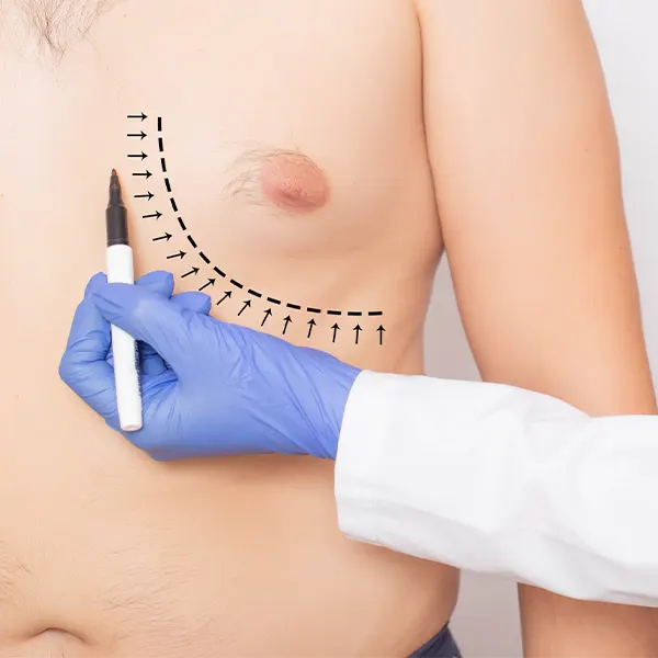 Img-gynecomastia-surgery-in-bogota-colombia-2
