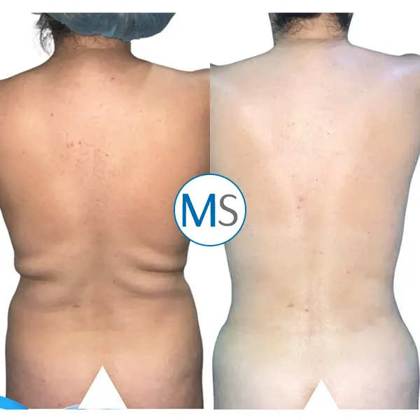 Img-liposuction-bogota-colombia-1