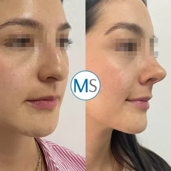 Img-rhinoplasty-bogota-colombia-1