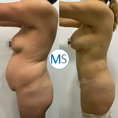 Img-tummy-tuck-surgery-in-bogota-colombia-1-LCP