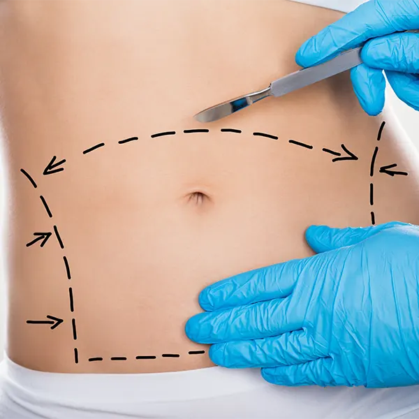 Img-tummy-tuck-surgery-in-bogota-colombia-2