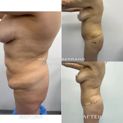 Img-Dr_Mauricio_Serrano-Before&After-2026-Lipectomy-1