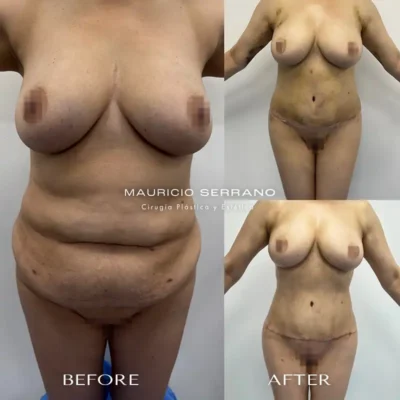 Img-Dr_Mauricio_Serrano-Before&After-2026-Lipectomy-4