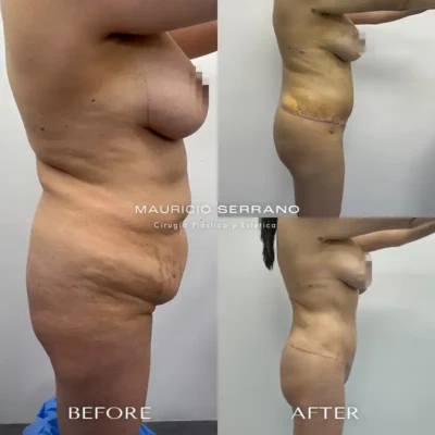 Img-Dr_Mauricio_Serrano-Before&After-2026-Lipectomy-5