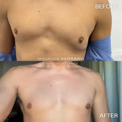 Img-Dr_Mauricio_Serrano-Before&After-2026-Gynecomastia-1