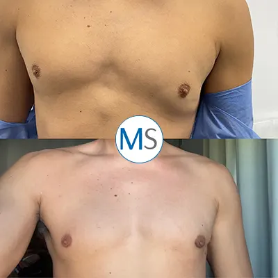 Img-gynecomastia-surgery-in-bogota-colombia-2-LCP